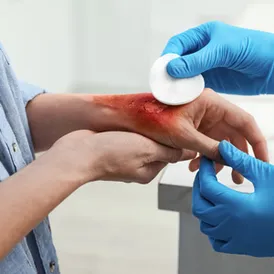 Burned in an accident — Hirsch Talcott can help.